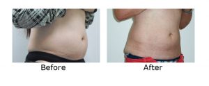 Fat freezing abdominal fat before after picture | female abdominal fat cryolipolysis treatment - ICE AESTHETIC UK