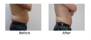 Fat freezing belly fat of man before after picture | Male abdominal fat cryolipolysis treatment for men - ICE AESTHETIC UK