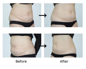 Fat freezing belly fat before after picture | female belly fat cryolipolysis treatment - ICE AESTHETIC UK