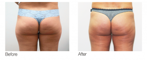 Fat freezing outer thighs before after picture | female outer thighs after cryolipolysis treatment - ICE AESTHETIC