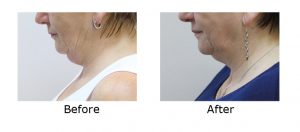 Cryolipolysis fat freezing treatment double chin - ICE AESTHETIC
