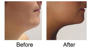 Fat freezing double chin fat of woman before after picture | Female chin fat cryolipolysis treatment - ICE AESTHETIC